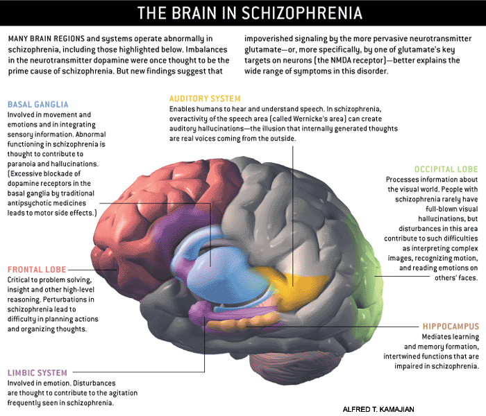 Image of A Schizophrenic Brain. Alfred Kamajian. http://schizophrenia.com/schizpictures.html#